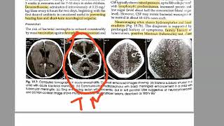 Pediatrics 569 Tuberculous meningitis Rich foci HYDROCEPHALUS Tuberculosis child [upl. by Iadam]