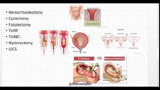 spinal anesthesia part 2Indications and contraiindications [upl. by Kissie]