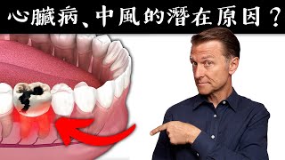 心臟病、中風的奇特原因 吃脂質維生素C自然療法柏格醫生 Dr Berg [upl. by Remle]