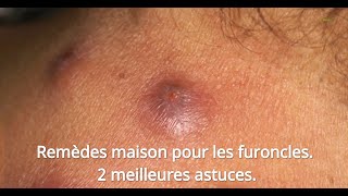 Remèdes Maison Pour Les Furoncles 2 Meilleures Astuces [upl. by Odetta]