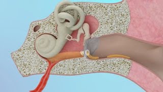 Clogged Ear Due to Ear Infection or Eustachian Tube Dysfunction [upl. by Chubb48]