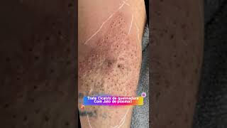 Tratamento de cicatriz com jato de plasma jatodeplasma esteticafacial rejuvenescimentofacial [upl. by Yentiw529]