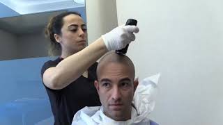 Hair Transplant in Turkey  Clinicana Istanbul [upl. by Nolasba]