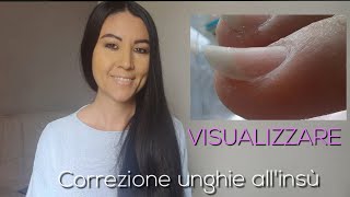 Visualizzare💅  Lezione 5 Correggere le unghie che crescono verso lalto  Ep 38 [upl. by Katherine]