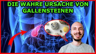 Die WAHRE Ursache von GALLENSTEINEN  quotDa kommt mir die GALLE hochquot [upl. by Atinej]