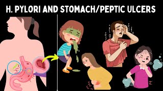 H pylori Causes of stomachPeptic Ulcer symptoms diagnosis treatment in Hindi🤔 [upl. by Yanahc]