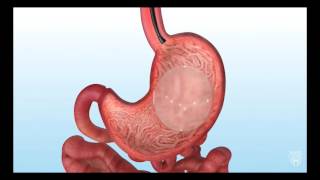 Endoscopic Gastric Balloon for Bariatric Weight Loss [upl. by Ecraep]