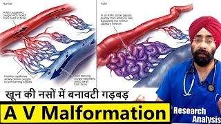 What are AV Malformations  खून की नसों में बनावटी गड़बड़  DrEducation [upl. by Nolitta]