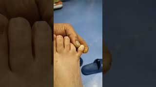 nails toenailfungus anxietydisorder satisfying impactedtoenail [upl. by Orimar]