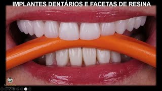 Transformação do Sorriso com Implantes Dentários e Facetas de Resina [upl. by Idnahr]