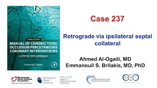 Case 237 Manual of CTO PCI  Retrograde via an ipsilateral septal collateral [upl. by Littell]