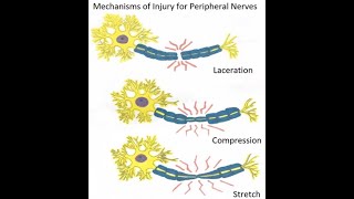 Peripheral nerve injuries classification and Wallerian degeneration [upl. by Heall]