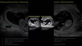 Monochorionic Monoamniotic amp Monochorionic Diamniotic Twins Ultrasound Scan  Pregnancy USG shorts [upl. by Farnham]