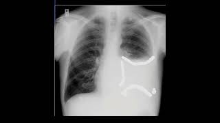 Chest Xray in Pleural Effusion How to Explain the findings [upl. by Odrareg]