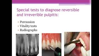 45The difference between reversible pulpitis and irreversible pulpitisMFDSMJDFORE [upl. by Neelram]