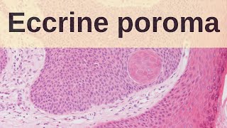 Eccrine Poroma  Pathology mini tutorial [upl. by Encratia]