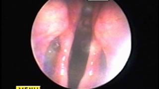 Abnormal Layngeal FunctionLaryngeal Paralysis [upl. by Oznole]