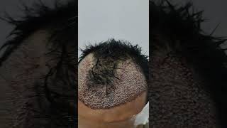 Unshaved hair transplanthair hairlosstreatment hairlinetransplant hairtransplanthelpline [upl. by Calloway463]