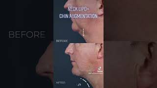 How to Achieve a Defined Jawline Chin Augmentation and Neck Liposuction Before and After [upl. by Arezzini587]