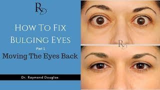 How To Fix Bulging Eyes  Part 1  Moving The Eyes Back [upl. by Maurreen]