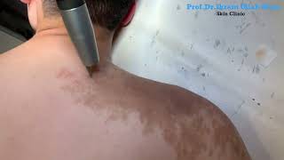 Banish Beckers Nevus with Revlite SI Laser Treatment birthmark lasertreatment [upl. by Animsaj658]