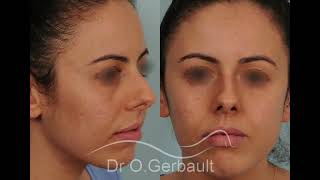 rhinoplastie Le morphing du nez  la rhinoplastie chirurgie du nez [upl. by Eittam607]