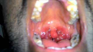 Acute Tonsillitis with Tonsillar exudates [upl. by Ayatnwahs]