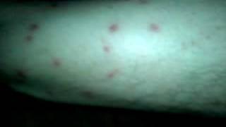 Chiggers Attacked on the 4th of July [upl. by Halimak]