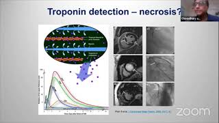 ECG Basic and Beyond  Lecture 85  Case Studies in ECG [upl. by Broeker]