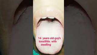 Swollen Tonsil  tonsillitis  shorts [upl. by Gerge279]