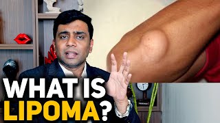 What Is Lipoma Explained by Dr Rajeev [upl. by Sakram]