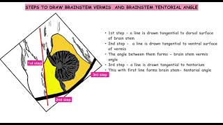 Brainstemvermis angle brainstem tentorial angle Blakes pouch Dandy Walker vermian hypoplasia [upl. by Nostets]