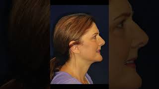 Dr Brian Harmych  Deep Plane Facelift Before and After Photos [upl. by Enihpled]