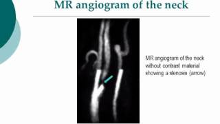 Your Radiologist Explains MR Angiography of the Brain and Neck [upl. by Eetnod]