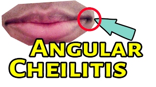 Angular Cheilitis Treatment  Angular Cheilitis Home Remedies [upl. by Brecher]