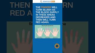 Raynauds disease in Rheumatoid Arthritis patients [upl. by Scrogan]