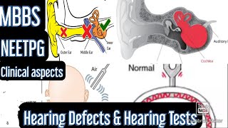 Hearing Defects amp Hearing Tests Rinnes test Webers test Schwabachs test mbbs neetpg [upl. by Aihsinat]