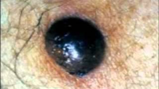 Melanoma what to look for  Dermatology and Laser Center of Charleston [upl. by Drugi64]