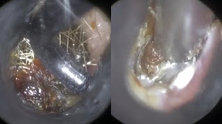 84  Complex Referred Ear Wax Removal with WAXscope®️ [upl. by Omidyar]