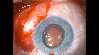 Recentration of a Subluxated Diffractive Bifocal Intraocular Lens [upl. by Ramey]