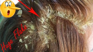 Big Flakes Of Dandruff On Scalp Removal in Hair Itchy Scalp Psoriasis Treatment  262 [upl. by Bonilla]