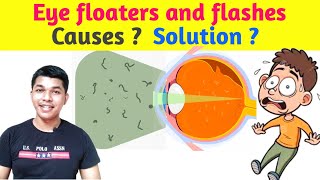 What causes Eyefloaters Eye Flashes  How to cure eyefloaters  SCIENCE COLLECTOR [upl. by Stedmann475]