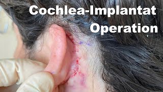 Cochlea Implantat die Operation Risiken amp Folgen [upl. by Gastineau]