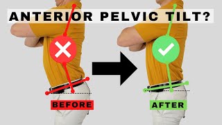 How to Fix Anterior Pelvic Tilt  Dr Jon Saunders [upl. by Hodess]