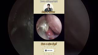 귀지형 콧물 부비동염 축농증 비염 코청소 이비인후과 rhinorrhea rhinitis sinusitis asmr ENT ENTdoctor [upl. by Arraes]