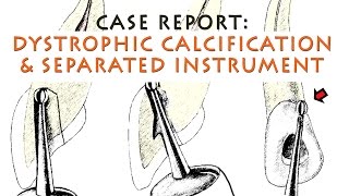 Dystrophic Calcification and Instrument removal [upl. by Tallulah]