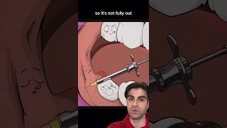 Animated Wisdom Tooth Removal [upl. by Sdlonyer]