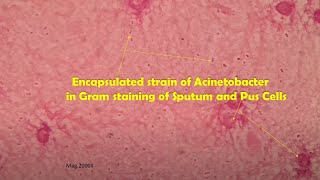 Acinetobacter in clinical sample Sputum Gram stain Microscopy at various magnifications [upl. by Nysa]