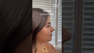 Before and immediately after chin filler injections with Dr Wise in Wayne NJ [upl. by Enaid657]