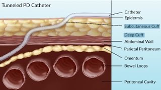 Complications of Peritoneal Dialysis by S Su  OPENPediatrics [upl. by Nimajaneb]